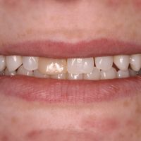 Dental Bonding before